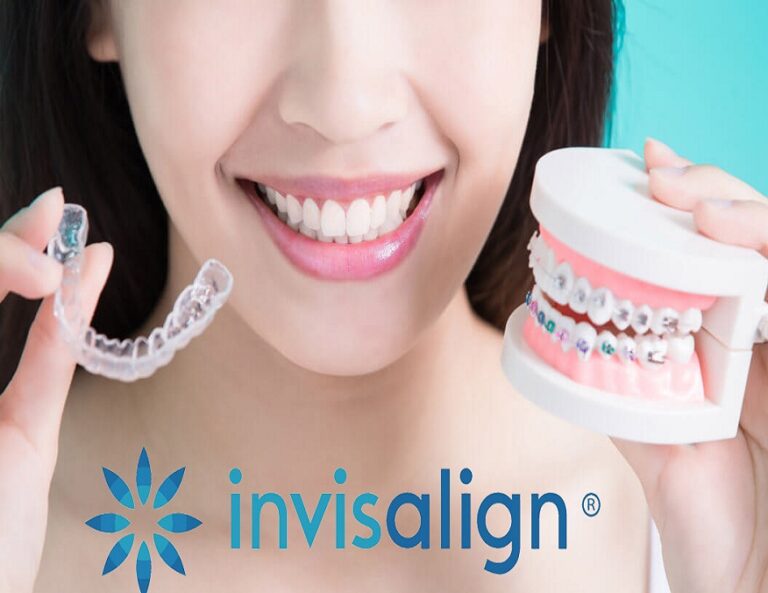 The Invisalign Revolution