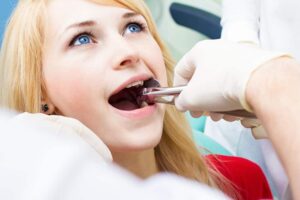 Wisdom Teeth Removal