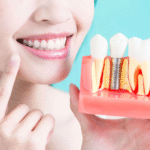 dental implants melbourne