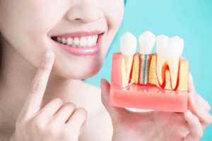 dental implants melbourne