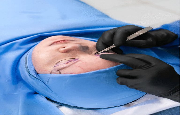 eyelid surgery