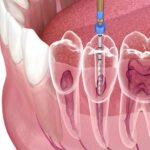 how root canal treatment works