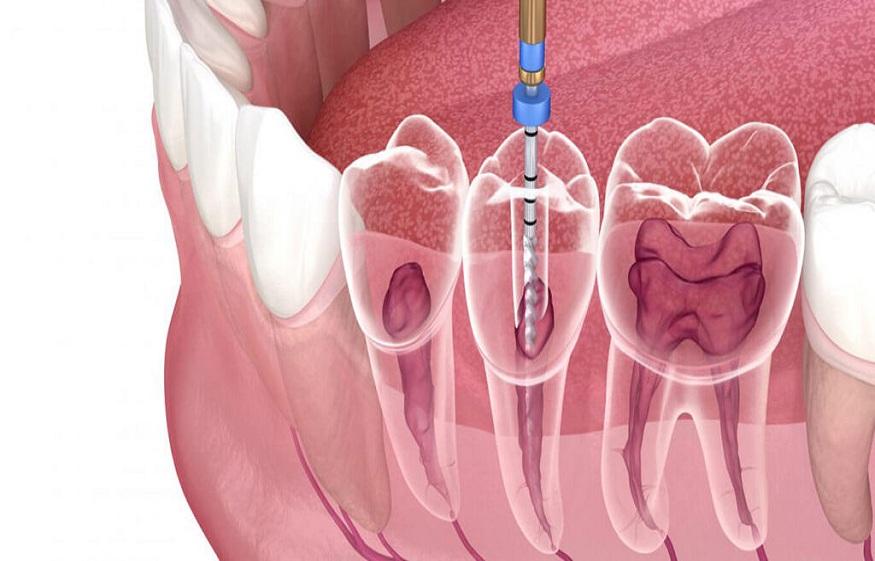how root canal treatment works