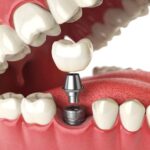 modern dental implants