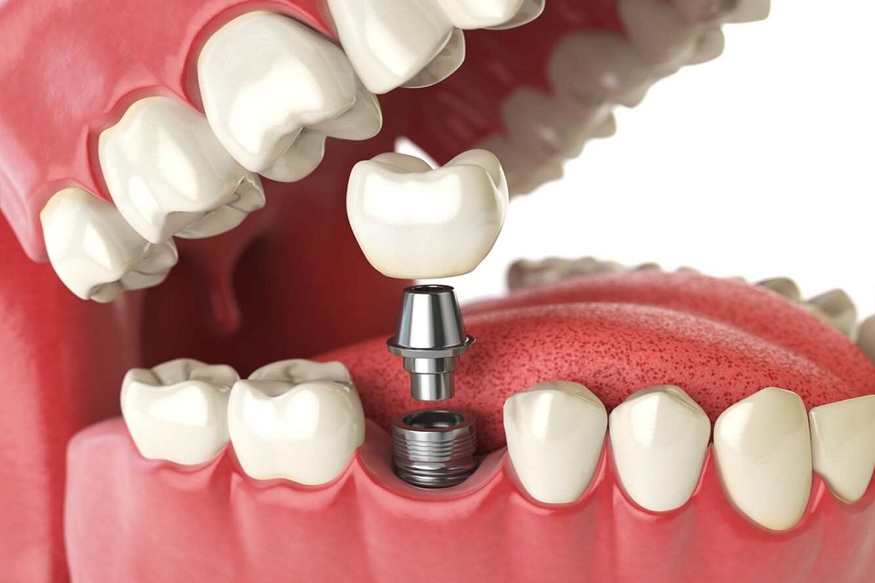 modern dental implants